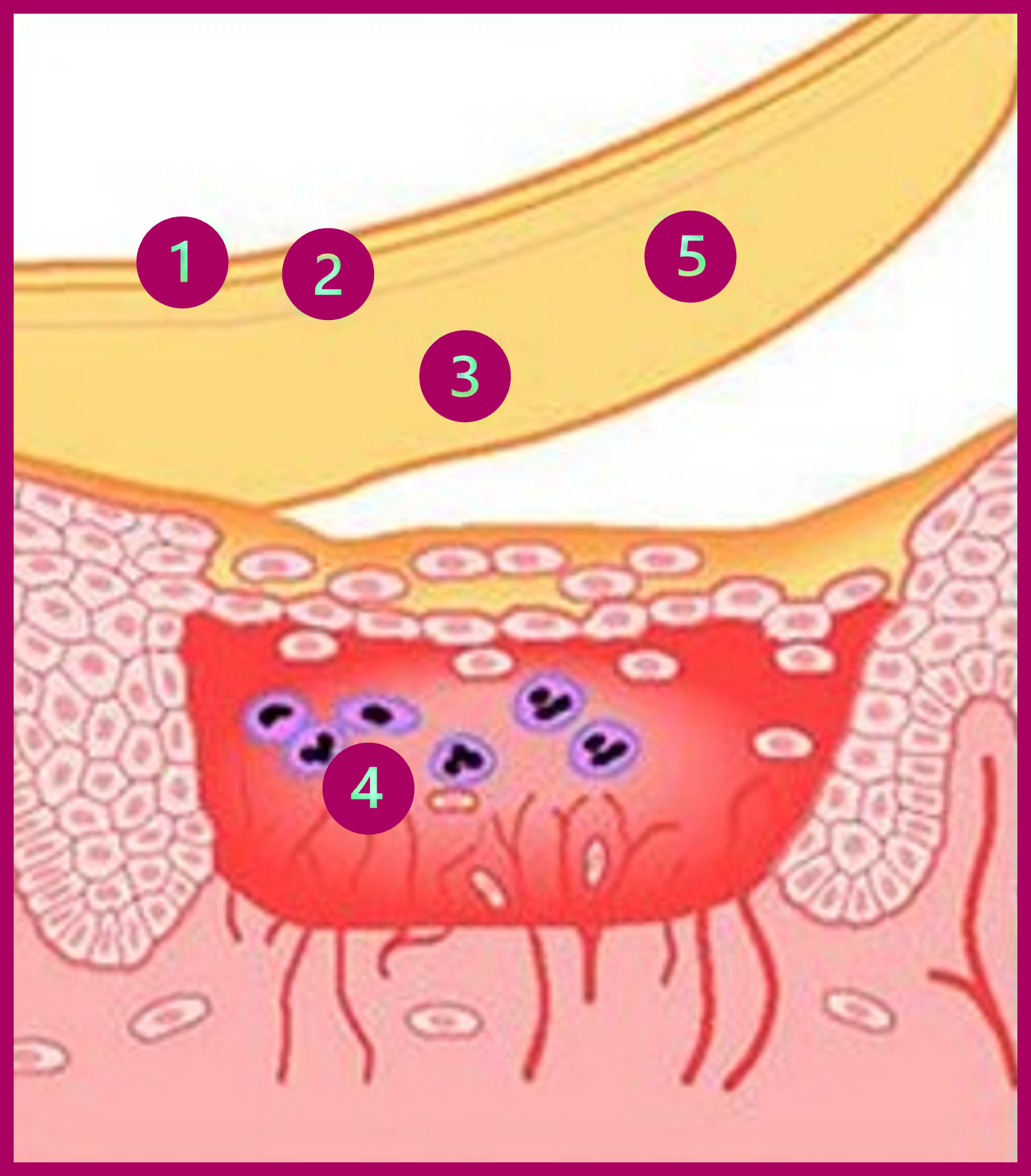 How DuoDerm® dressings work