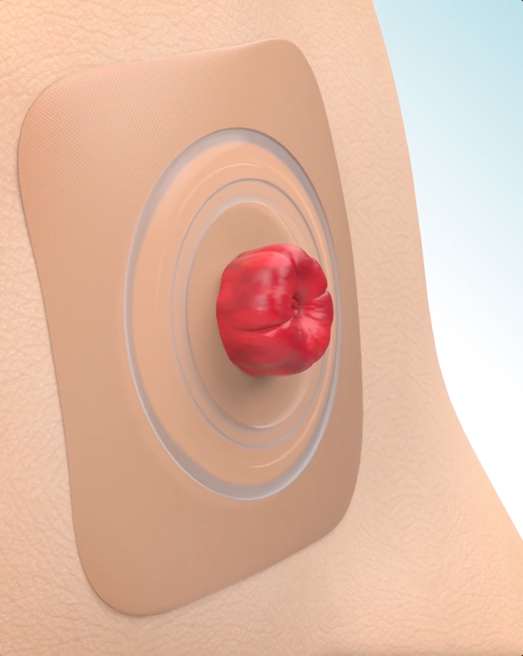 Vídeo que demonstra como funcionam os adesivos Convatec