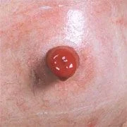 Protruding Stoma - Ostomy Basics